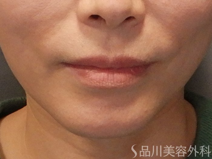 症例NO.69690のBEFORE写真