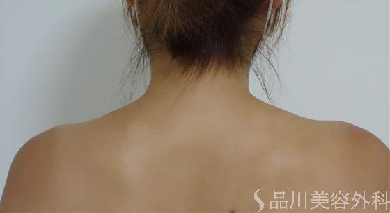 症例NO.48747のBEFORE写真