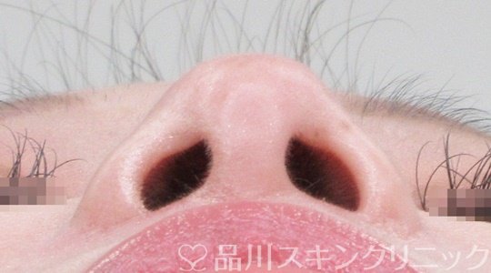 症例NO.69666のAFTER写真