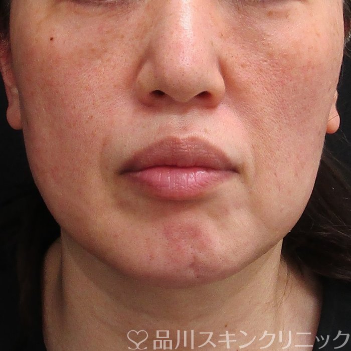 症例NO.73769のBEFORE写真