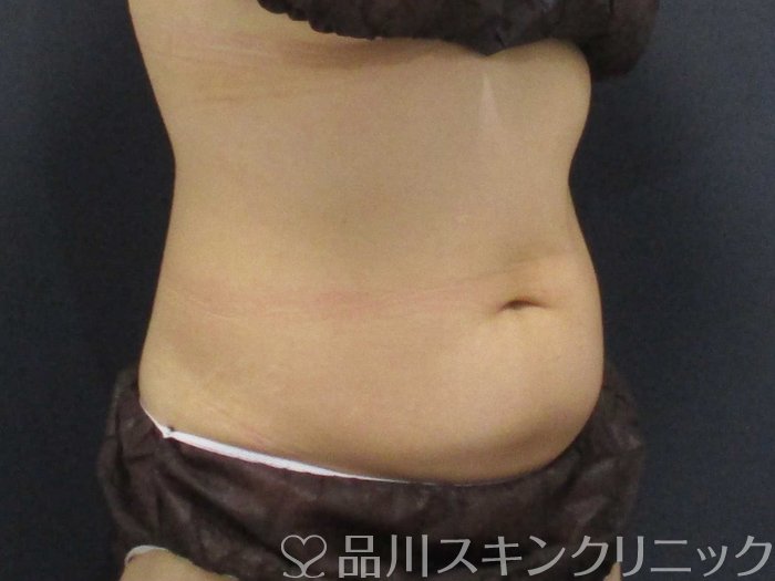 症例NO.70808のBEFORE写真