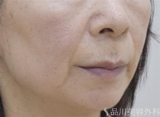 症例NO.49184のBEFORE写真