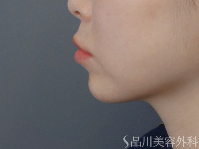 症例NO.72584のAFTER写真