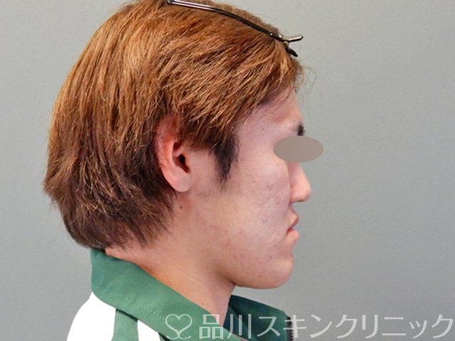 症例NO.69061のAFTER写真