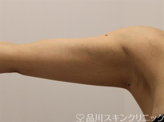 症例NO.45740のAFTER写真