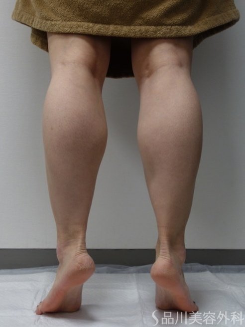 症例NO.74544のAFTER写真