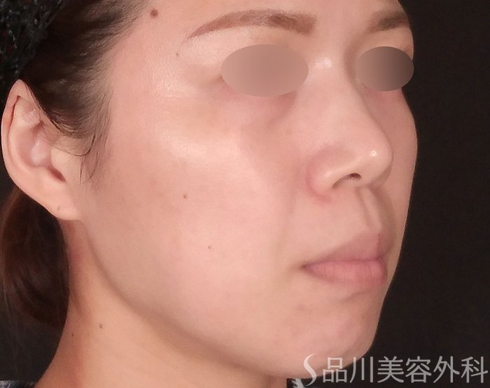 症例NO.70547のBEFORE写真