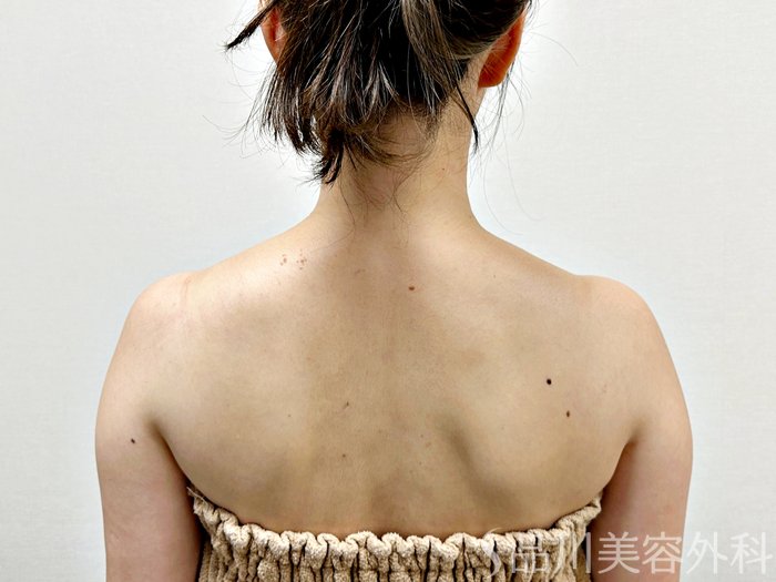 症例NO.73704のBEFORE写真