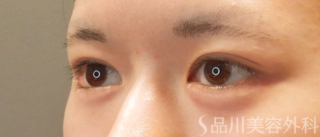 症例NO.73254のAFTER写真