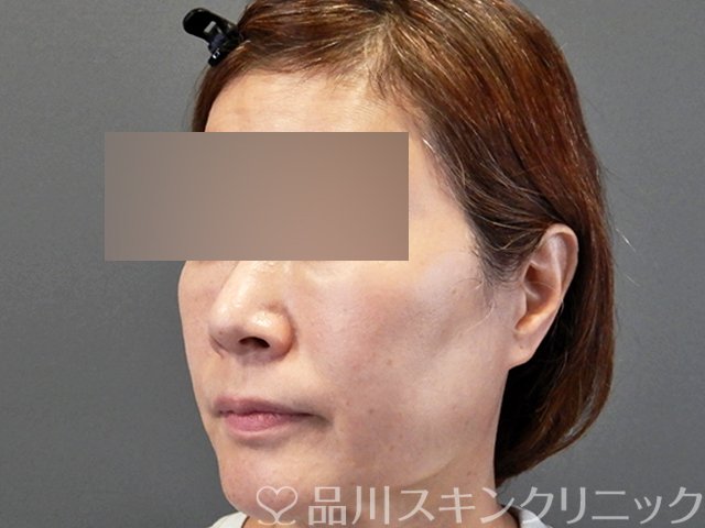 症例NO.66270のBEFORE写真