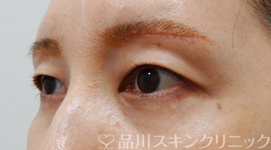 症例NO.70162のAFTER写真