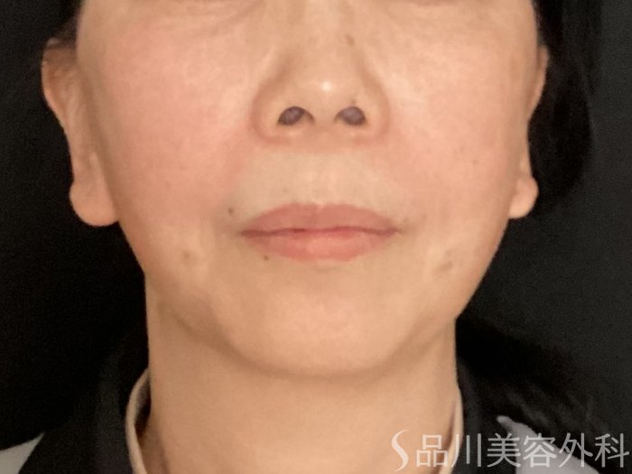 症例NO.65353のAFTER写真