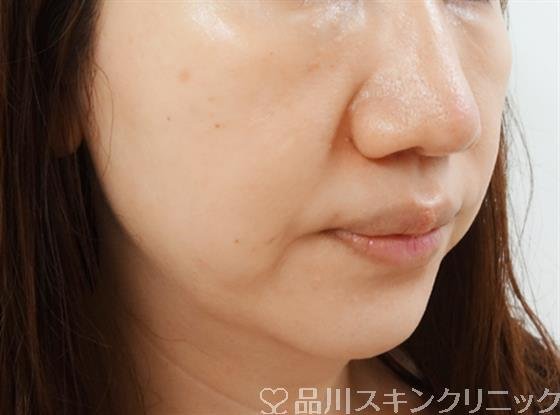症例NO.25723のBEFORE写真