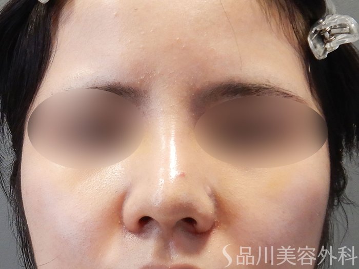 症例NO.71066のAFTER写真
