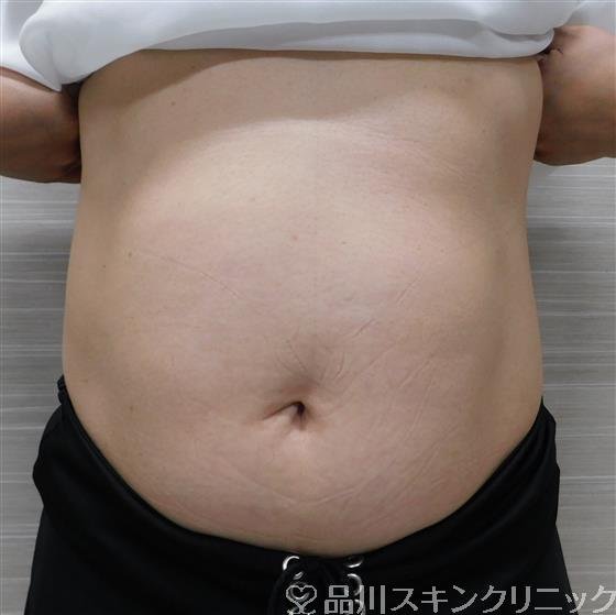 症例NO.48755のAFTER写真