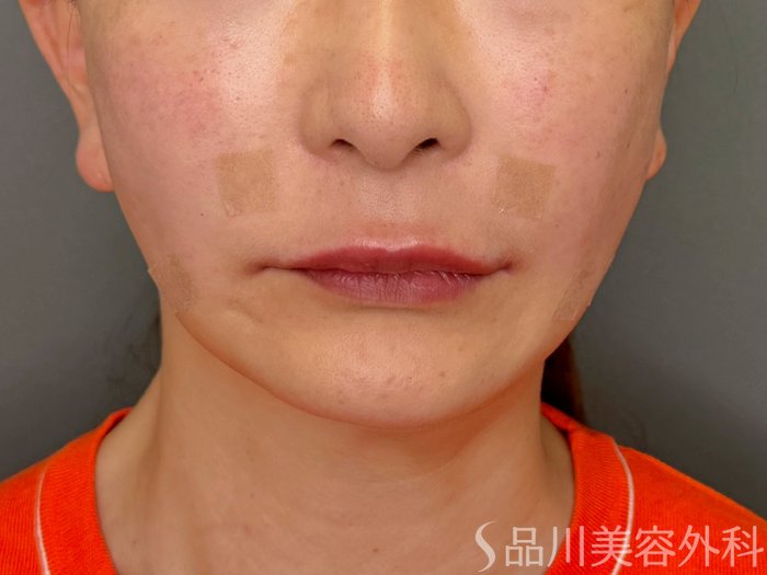 症例NO.71441のAFTER写真