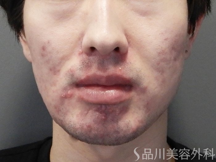 症例NO.73146のBEFORE写真