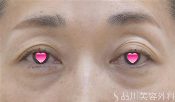 症例NO.45146のBEFORE写真