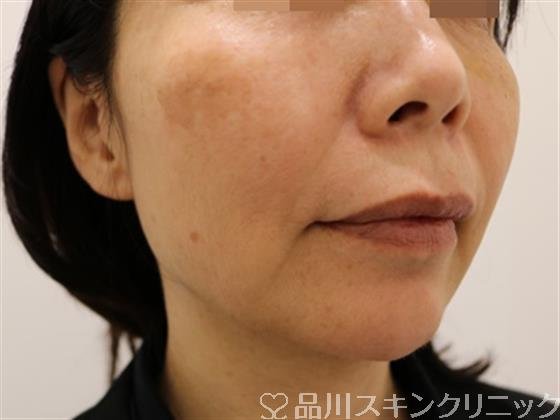 症例NO.40619のAFTER写真