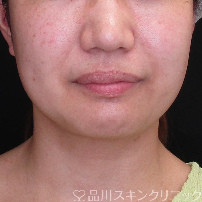 症例NO.74028のBEFORE写真