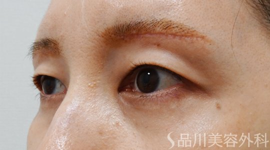 症例NO.70162のAFTER写真