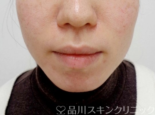 症例NO.65419のBEFORE写真