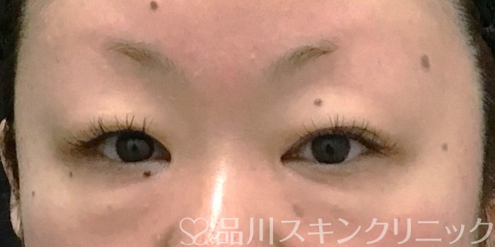 症例NO.70439のBEFORE写真