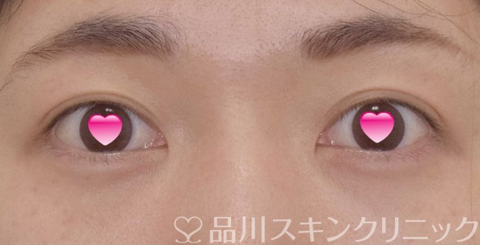 症例NO.64325のAFTER写真