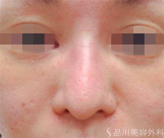 症例NO.60431のAFTER写真