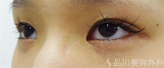 症例NO.36175のBEFORE写真