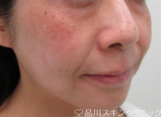 症例NO.34889のBEFORE写真