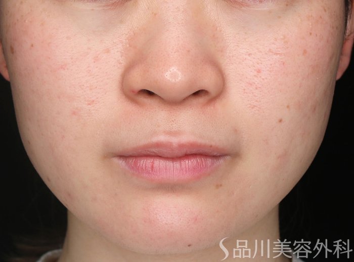 症例NO.72438のAFTER写真