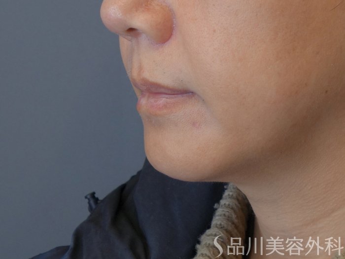 症例NO.72948のBEFORE写真