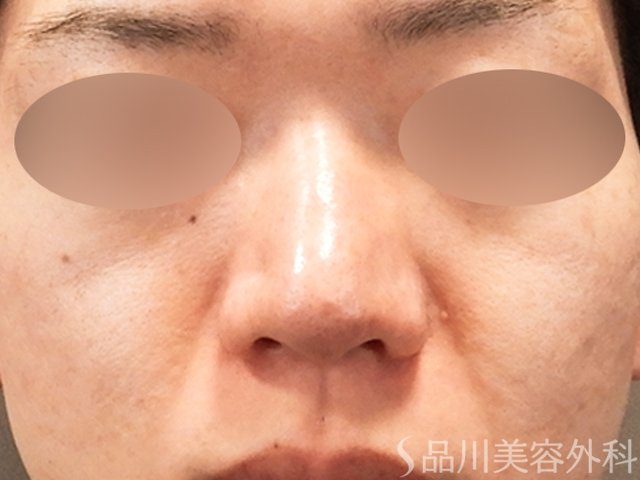 症例NO.70282のBEFORE写真