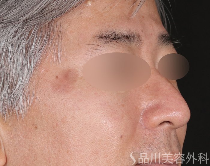 症例NO.71814のBEFORE写真
