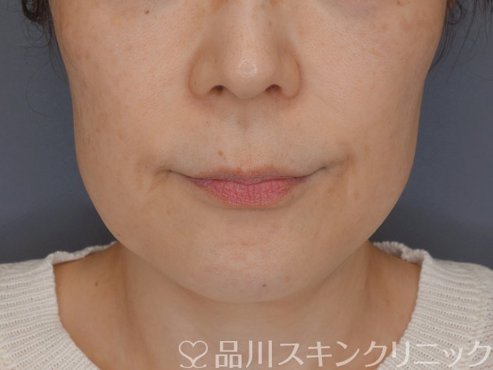 症例NO.72264のBEFORE写真