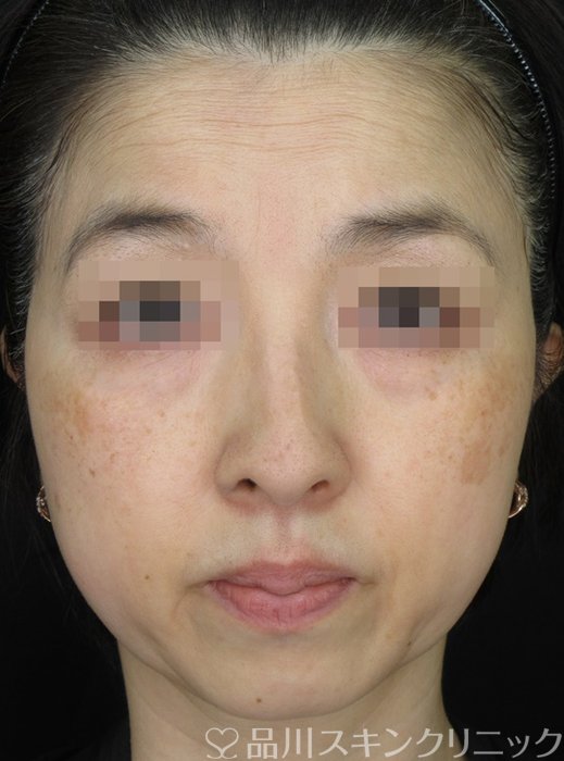 症例NO.70904のBEFORE写真