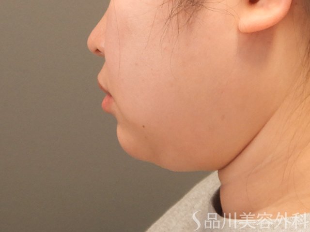 症例NO.71928のBEFORE写真