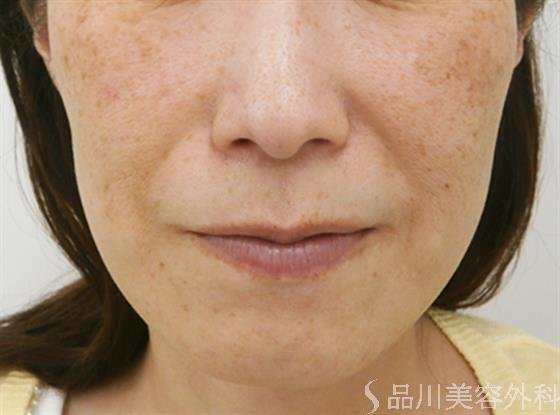 症例NO.31581のBEFORE写真