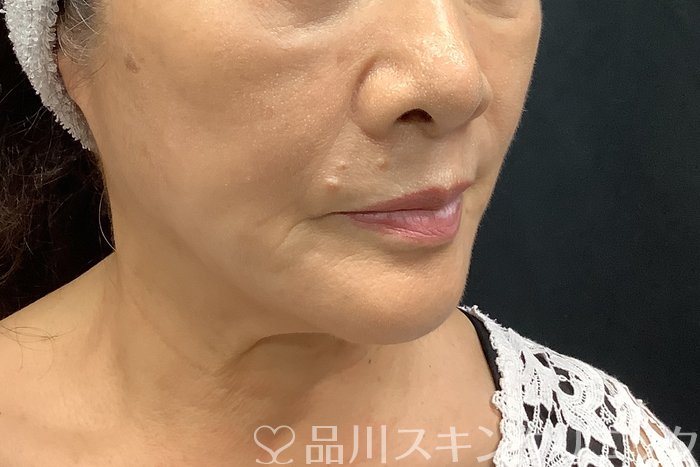 症例NO.69839のAFTER写真