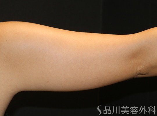 症例NO.70874のAFTER写真