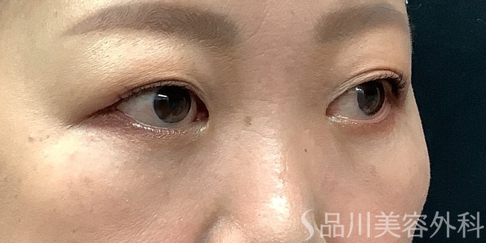 症例NO.71236のAFTER写真