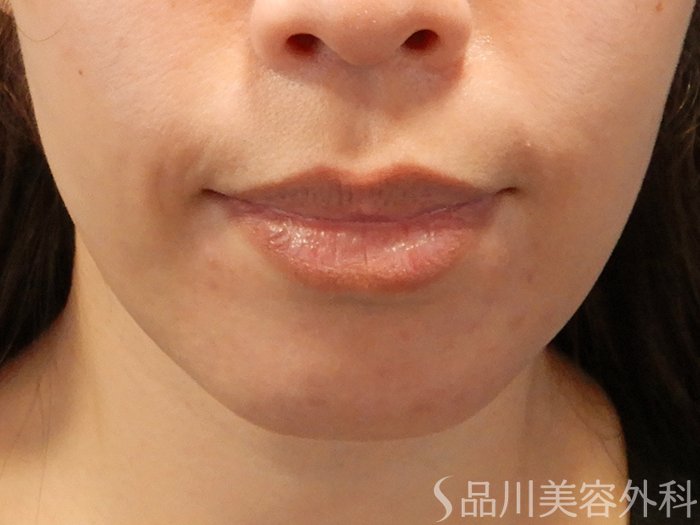 症例NO.69423のBEFORE写真