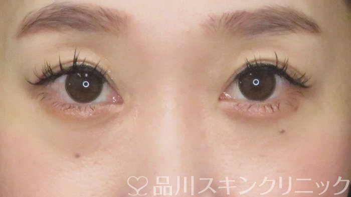 症例NO.67647のBEFORE写真