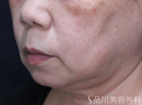 症例NO.74093のBEFORE写真