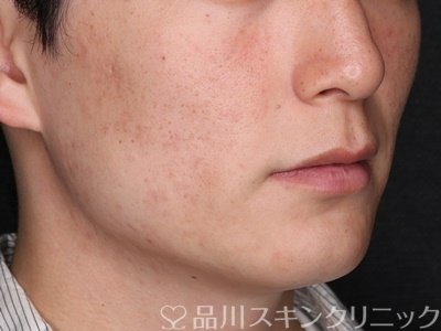 症例NO.74115のAFTER写真