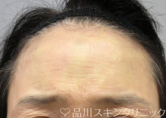 症例NO.72747のAFTER写真