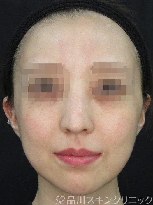 症例NO.72463のBEFORE写真