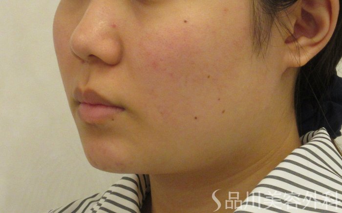 症例NO.71710のBEFORE写真