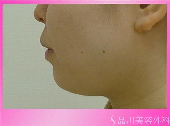 症例NO.44107のBEFORE写真